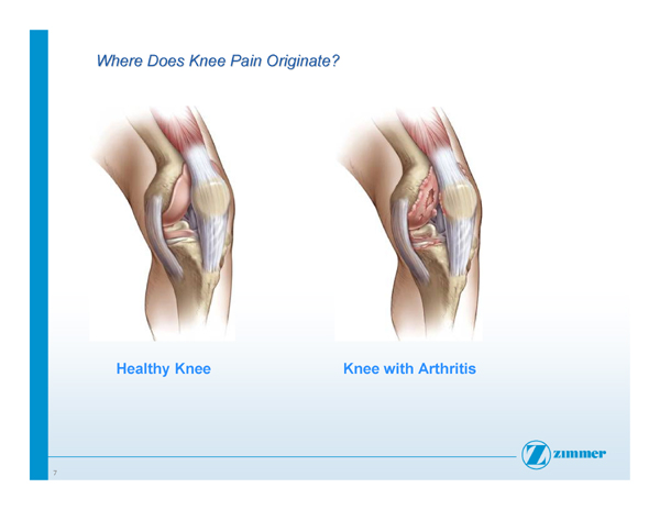 Slide 7- Where Does Knee Pain Originate?