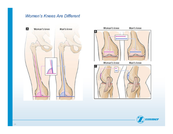 Slide 13- Womens Knees Are Different